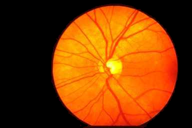 Optic Disc