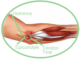 Tennis Elbow