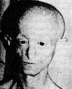 progeria3.jpg (4677 bytes)
