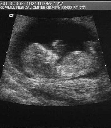 Ultrasound of D.J.